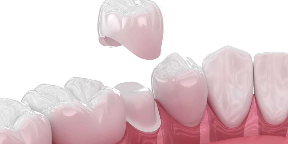 Dental Crown Dubai: How Long Do Crowns Last and How Should You Care for Them?