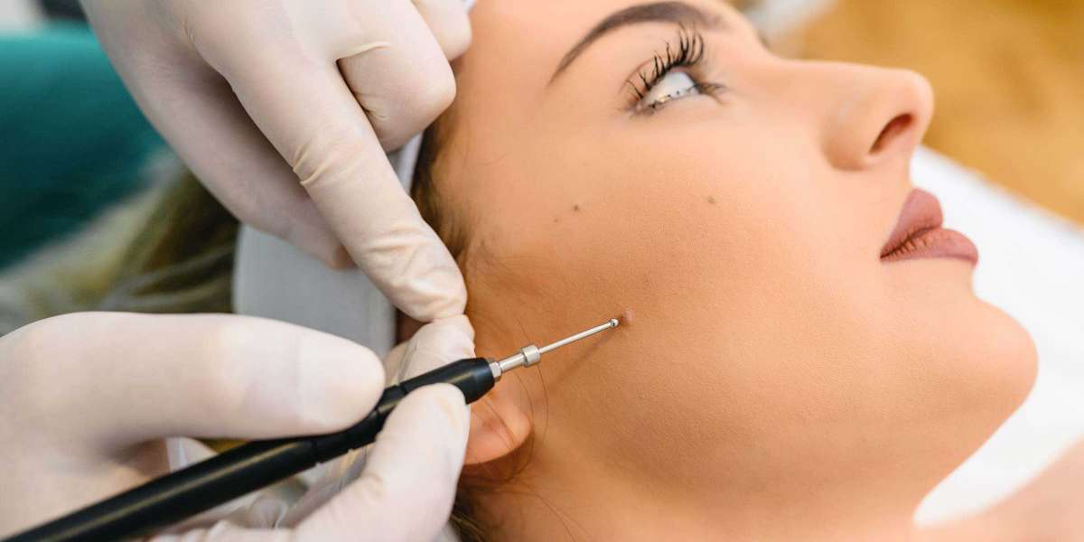 What Happens During Mole Removal in London Procedures