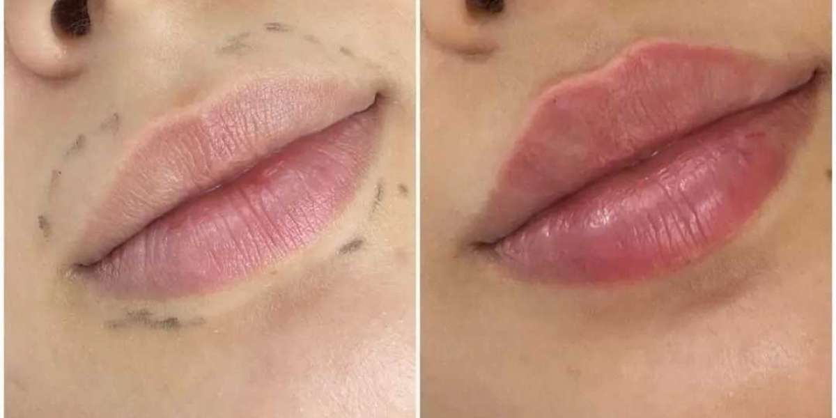 Juvederm Cost Breakdown at the Best Aesthetic Clinics in dubai