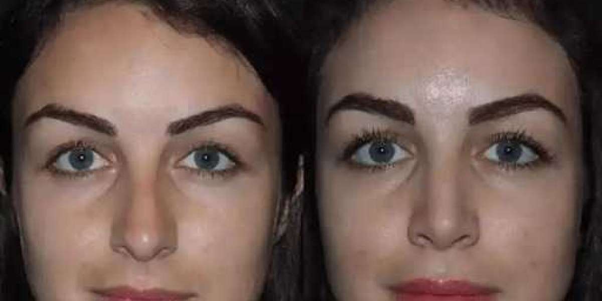 Rhinoplasty in Dubai: Why Customized Surgical Planning Matters